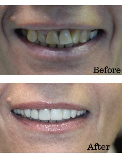 Cosmetic Crowns before and after Amelia Gentle Dentistry services