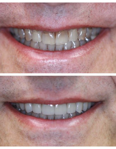 Cosmetic veneers before and after Amelia Gentle Dentistry services