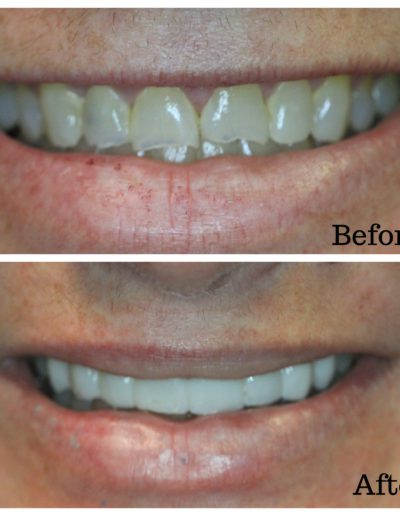Dental veneers by Amelia Gentle Dentistry