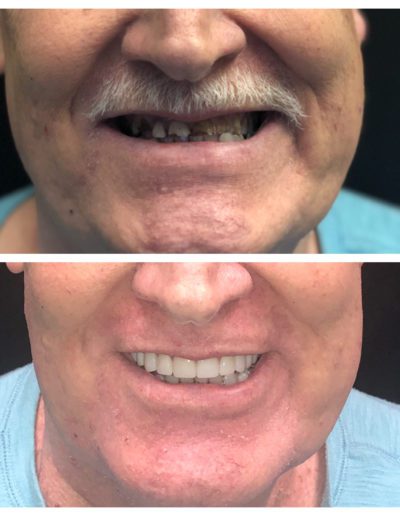Smile makeover by Amelia Gentle Dentistry