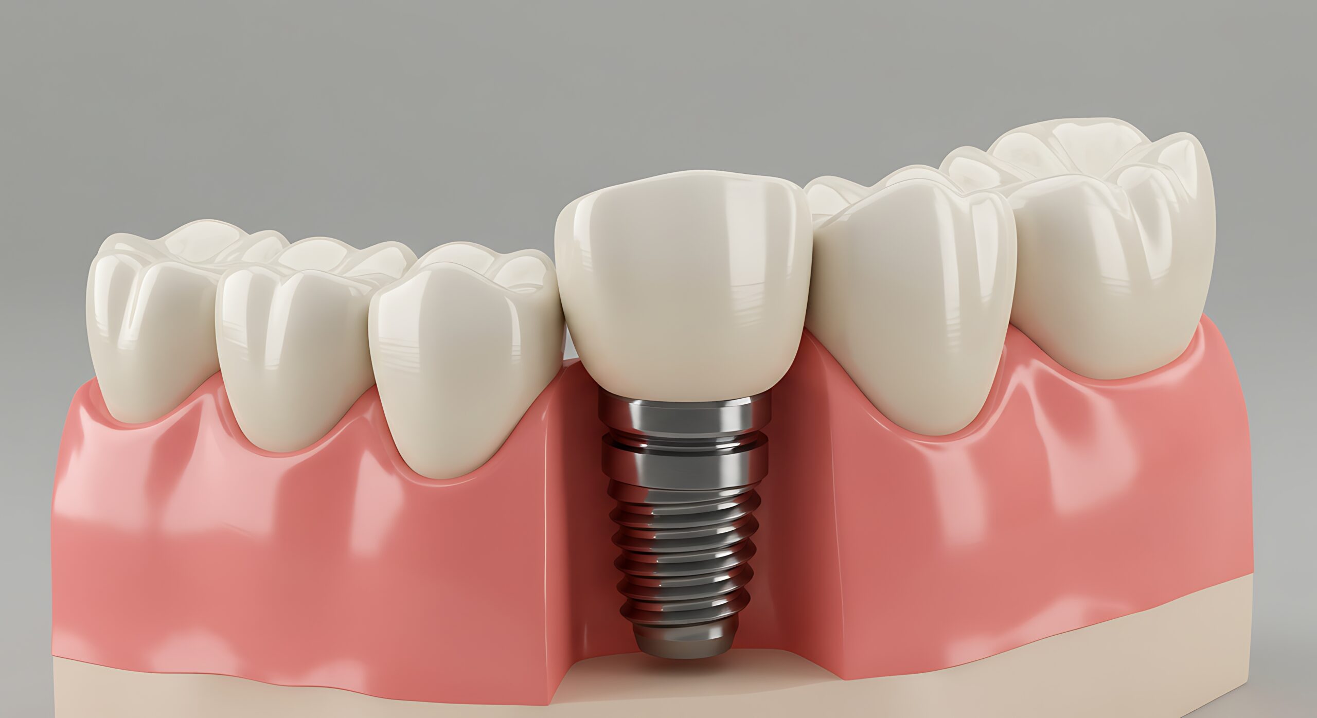 White dental implant. Dental implant. Implants can support a permanent single tooth crown, a multi-tooth bridge or even a full fixed denture